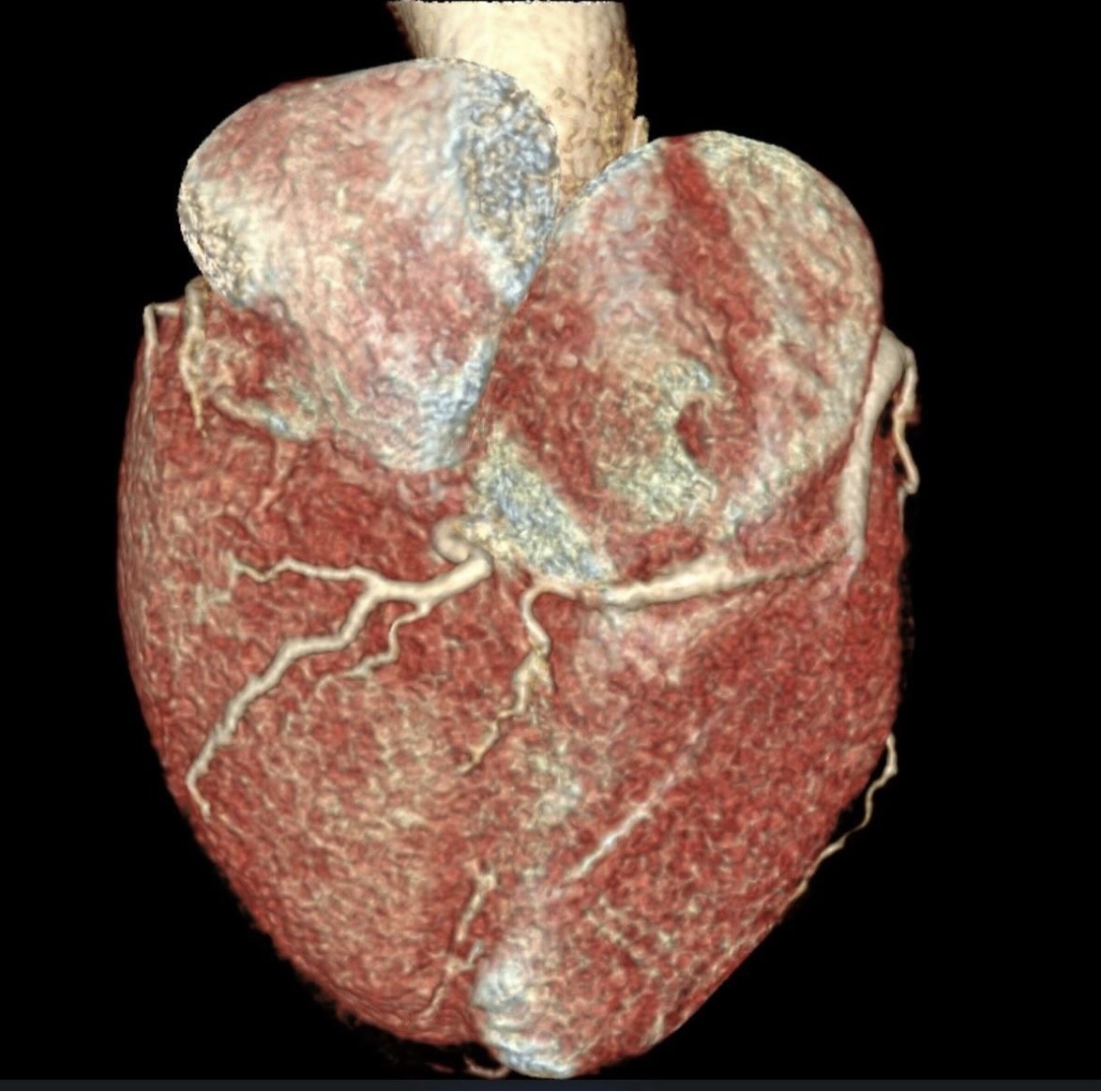 Visualización de arterias mediante AngioTAC